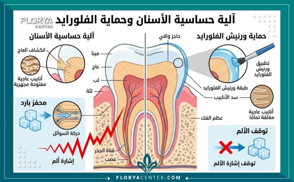 رسم تخطيطي يوضح أسباب حساسية الأسنان وكيفية سد مسامات المينا المكشوفة بواسطة ورنيش الفلورايد.