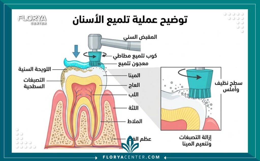 تلميع الاسنان في تركيا 2 رسم توضيحي طبي يشرح خطوات تلميع الأسنان وإزالة التصبغات السطحية وتنعيم طبقة المينا.