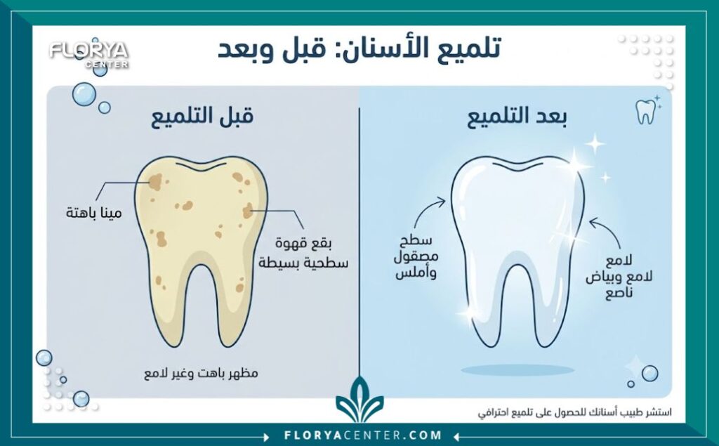 تلميع الاسنان في تركيا 3 إنفوجرافيك يوضح الفرق قبل وبعد تلميع الاسنان والتخلص من التصبغات للحصول على سطح أملس.