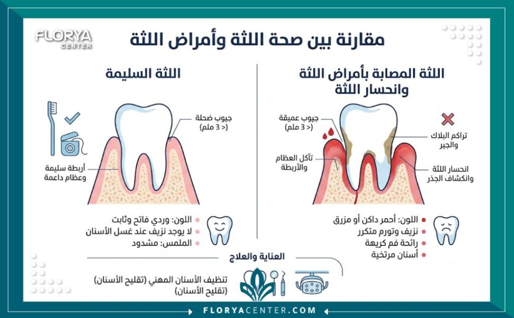 إنفوجرافيك يقارن بين اللثة السليمة واللثة المصابة بالتهاب وتراجع يتطلب علاج الجيوب اللثوية العميقة.