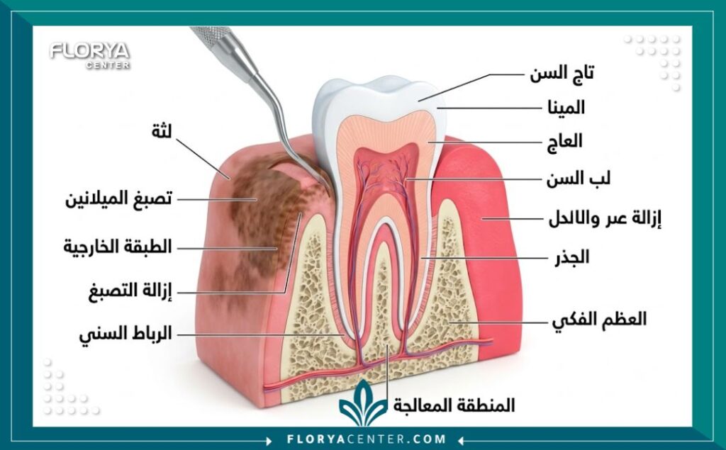 رسم توضيحي طبي لطبقات اللثة يشرح كيفية إزالة التصبغات الداكنة وتوريد اللثة جراحياً.