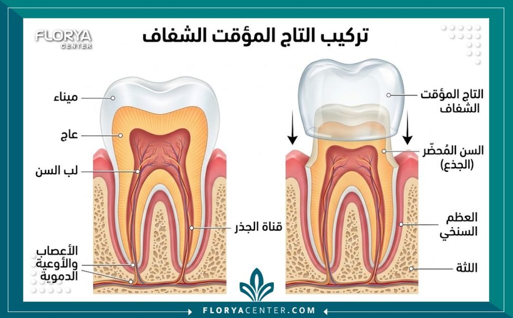رسم توضيحي طبي يبين كيف تحمي التركيبات البلاستيكية المؤقتة السن المبرود وتغلفه بالكامل.