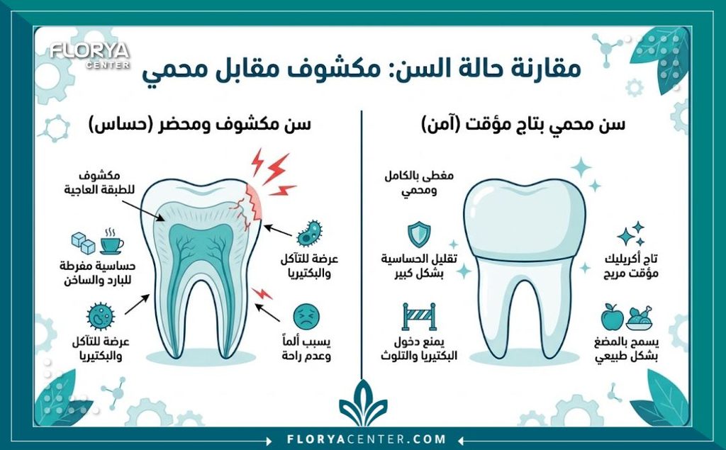 إنفوجرافيك يقارن بين السن المبرود المكشوف والسن المحمي بواسطة تيجان الاكريليك المؤقتة للحفاظ على العصب.