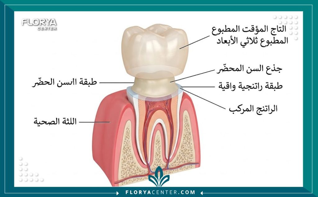 تيجان الريزين المركب في تركيا 2 رسم توضيحي طبي يظهر تركيب تاج الريزين المركب المؤقت لحماية السن بعد التحضير.