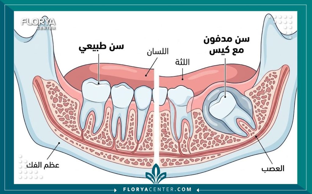 رسم تخطيطي طبي يوضح الفرق بين السن الطبيعي والسن المدفون داخل عظم الفك مع تكوّن كيس أسناني