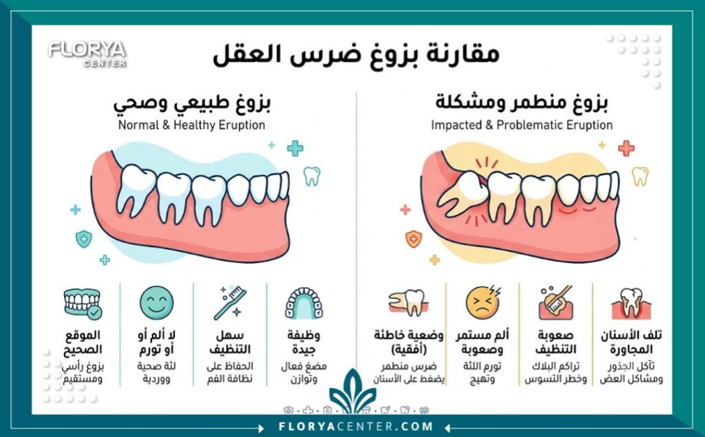 إنفوجرافيك طبي يوضح الفرق بين نمو ضرس العقل الطبيعي وحالة ضرس العقل الأفقي المنطمر الذي يحتاج إلى جراحة.