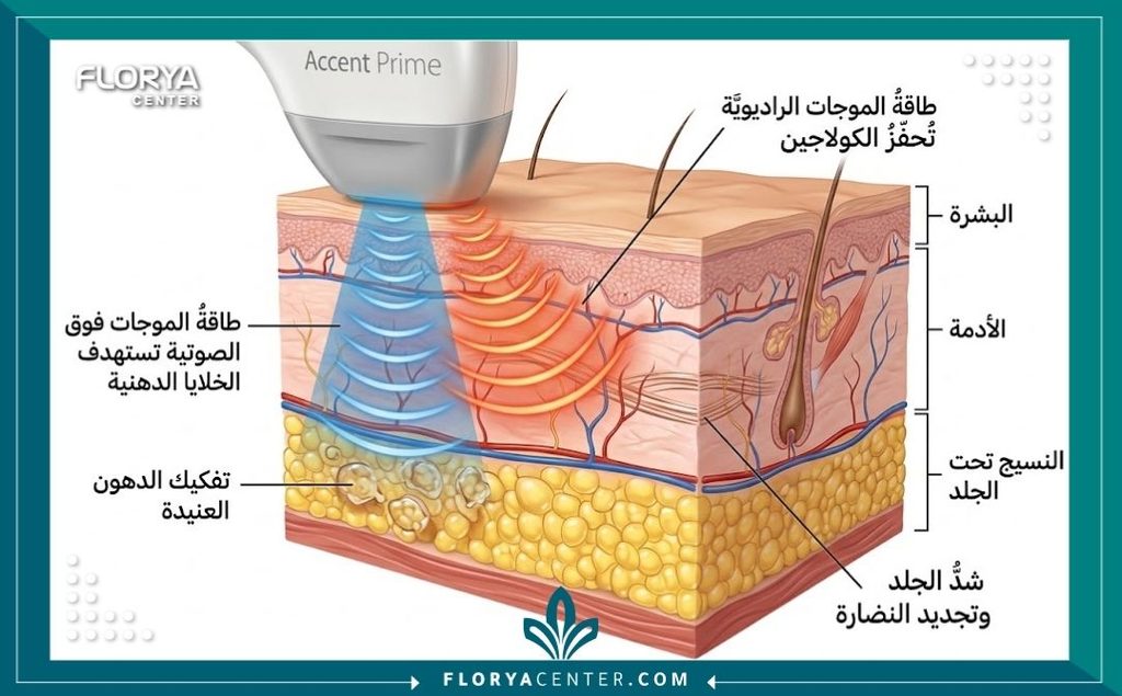 رسم توضيحي لآلية عمل جهاز أكسينت برايم لاختراق طبقات الجلد وتكسير الدهون وتحفيز الكولاجين لشد الترهلات.