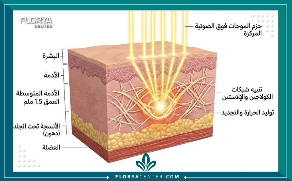 رسم توضيحي طبي لطبقات الجلد يوضح تقنية الموجات الصوتية لجهاز سوفت ويف واستهدافها لطبقة الأدمة لتحفيز الكولاجين.