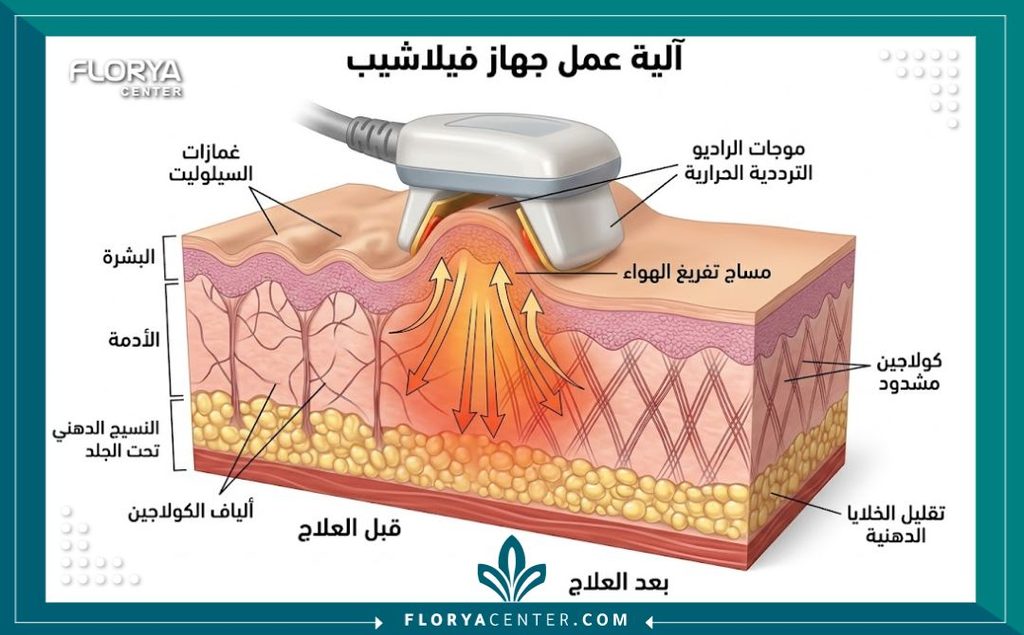 جهاز فيلاشيب لشد الجلد وعلاج السيلوليت 2 رسم توضيحي طبي ثلاثي الأبعاد لطبقات الجلد يوضح آلية عمل جهاز فيلاشيب لشد الجلد في تكسير الدهون.