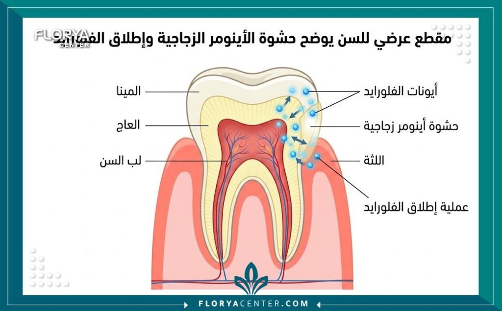رسم توضيحي طبي يوضح تشريح السن وآلية عمل حشوات الجلاس ايونومير في إفراز الفلورايد لحماية الأسنان.