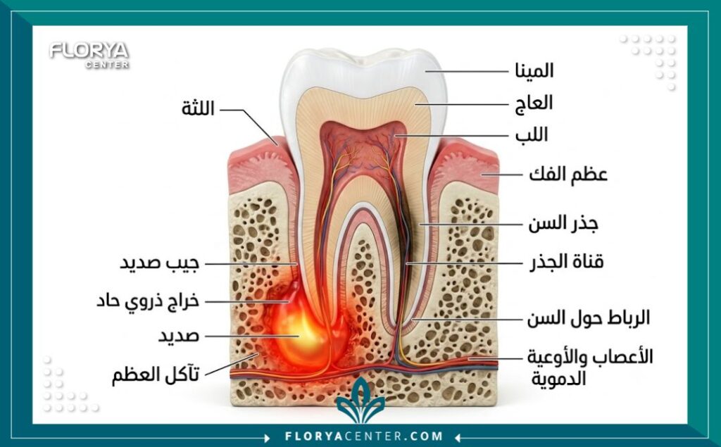 رسم توضيحي طبي دقيق يوضح تشريح الخراج السني وكيفية امتداد الالتهاب البكتيري وتجمع القيح في جذر السن وعظم الفك.