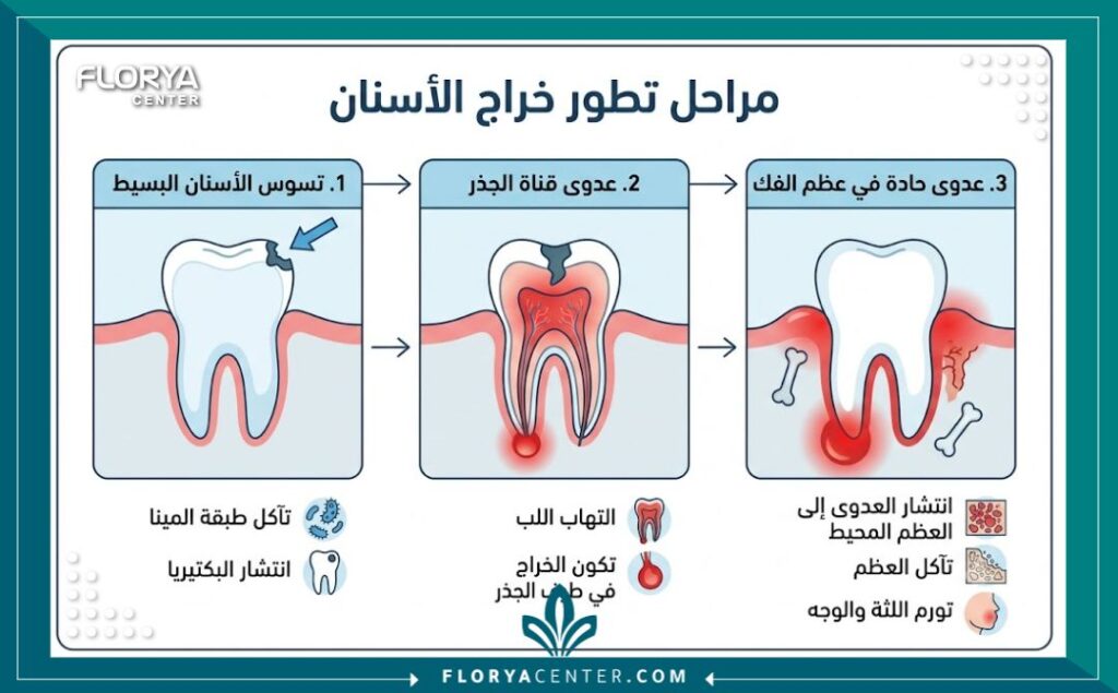 إنفوجرافيك طبي يوضح مراحل تطور خراج الأسنان من التسوس البسيط إلى التهاب العصب ثم تآكل عظم الفك.