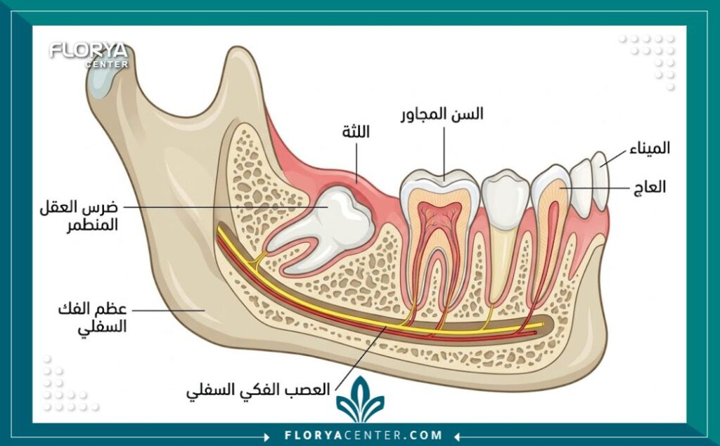خلع جراحي لضرس العقل المدفون 2 رسم توضيحي تشريحي يوضح ضرس العقل المدفون أفقياً تحت اللثة وعظم الفك السفلي.