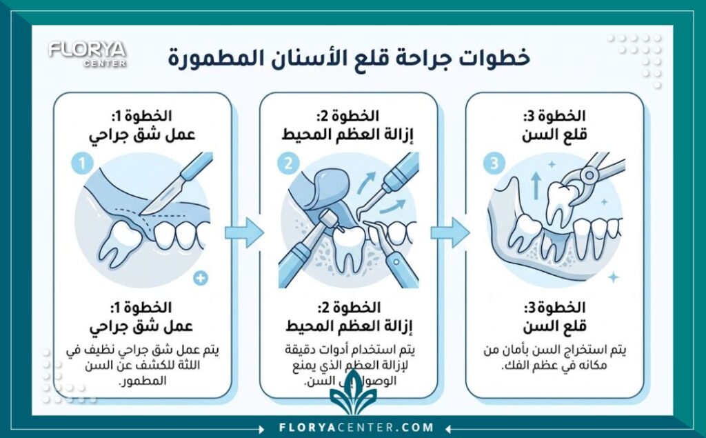 خلع جراحي لضرس العقل المدفون 3 إنفوجرافيك يشرح خطوات عملية خلع جراحي لضرس العقل المدفون من شق اللثة إلى استخراج السن.