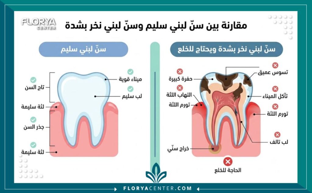 إنفوجرافيك طبي يوضح أسباب خلع ضرس الطفل والفرق بين السن اللبني السليم والسن التالف.