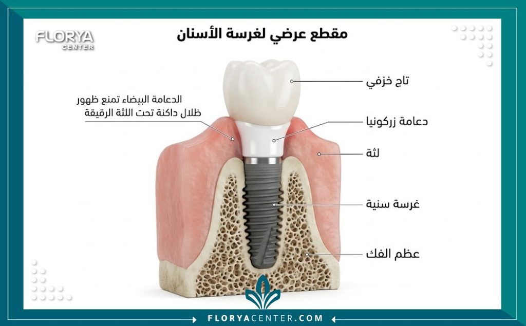 دعامات الزركون لزراعة الاسنان في تركيا 2 رسم توضيحي طبي لتركيب زراعة الأسنان يوضح دور دعامة الزركون البيضاء في منع ظهور اللون المعدني تحت اللثة الرقيقة.