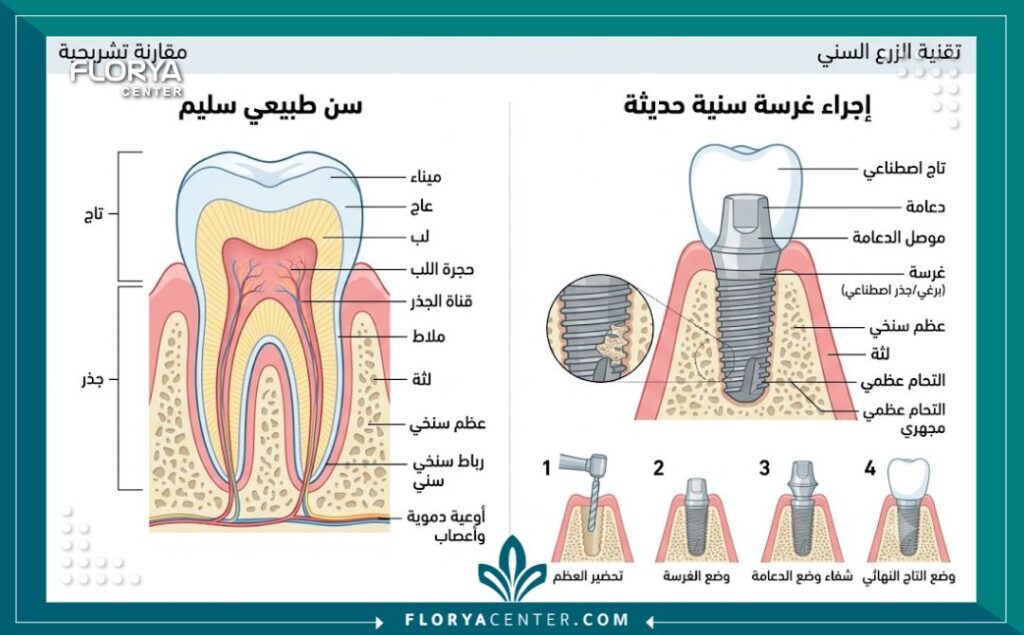 رسم توضيحي طبي يوضح تفاصيل زراعة الأسنان، من تنفيذ عيادة طبيبة أسنان عربية متخصصة في تركيا.