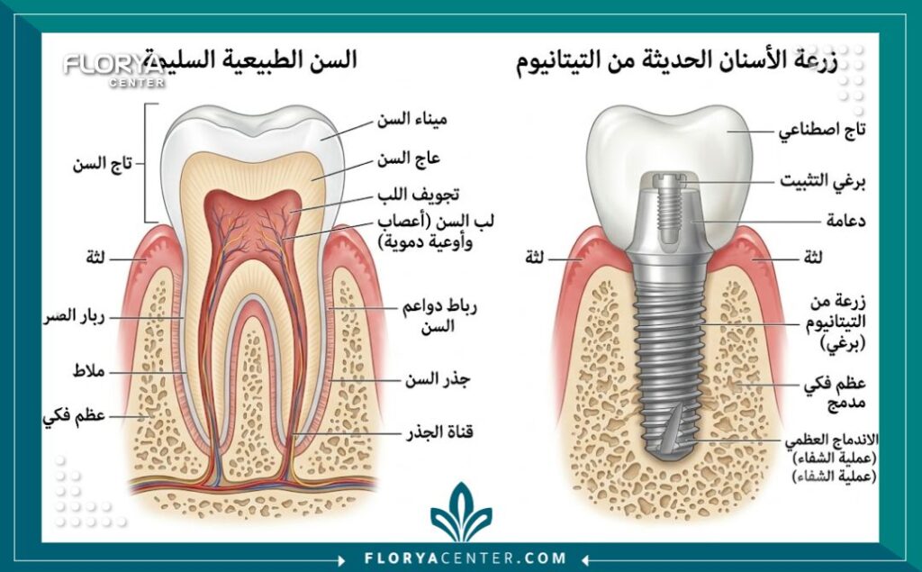 دكتور اسنان ممتاز ورخيص في تركيا 2 رسم توضيحي طبي يوضح تشريح السن وخطوات زراعة الأسنان في تركيا.