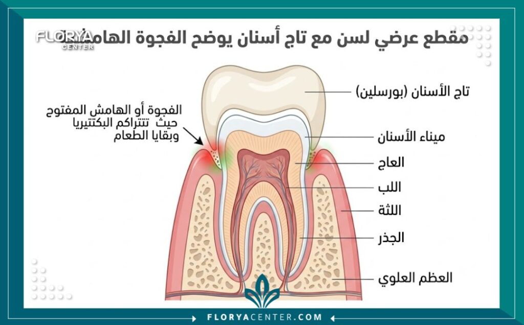 رائحة كريهة من تلبيسة الاسنان 2 رسم توضيحي طبي يظهر تراكم البكتيريا تحت التلبيسة القديمة المسببة لظهور رائحة كريهة من تلبيسة الاسنان.
