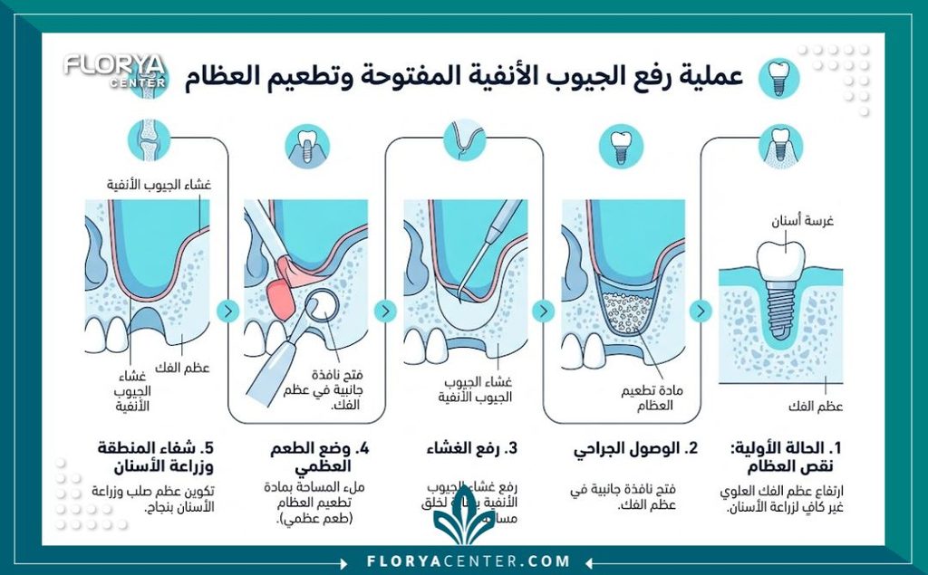 رفع الجيب الفكي المفتوح في تركيا 3 إنفوجرافيك يوضح خطوات الجراحة الكبرى لرفع الجيب الفكي المفتوح وتطعيم العظم لتهيئة الفك لزراعة الأسنان.