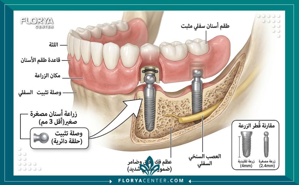 رسم توضيحي طبي لتركيب زراعة الاسنان المصغرة في حالات الفك الذي يعاني من ضمور العظم الشديد.