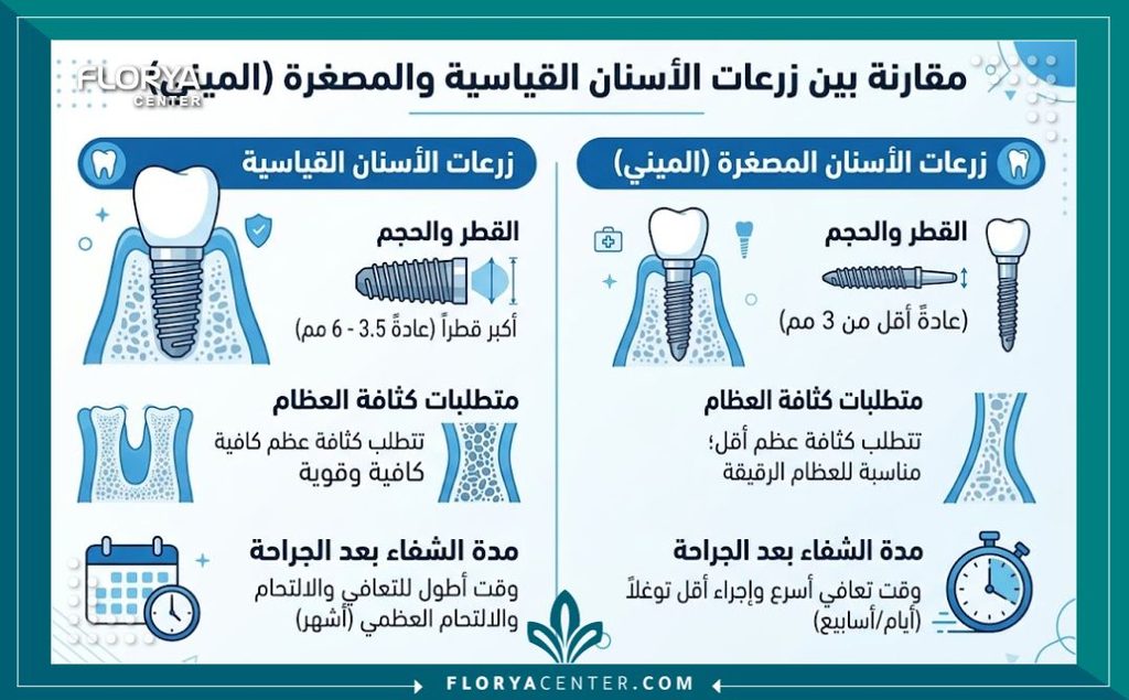 إنفوجرافيك يقارن بين زراعة الأسنان التقليدية وزراعة الاسنان المصغرة ومميزات كل منهما لمرضى العظم الضعيف.