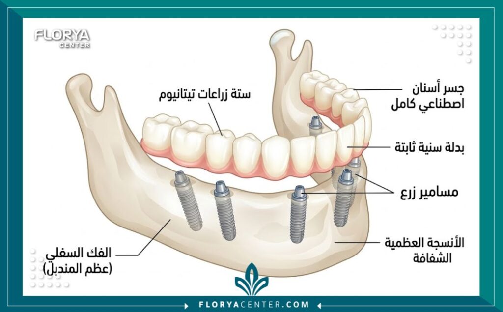 زراعة الاسنان All-on-6 في تركيا 2 رسم توضيحي طبي ثلاثي الأبعاد يبين أماكن توزيع 6 زرعات تيتانيوم لثبات الفك في تقنية All-on-6.
