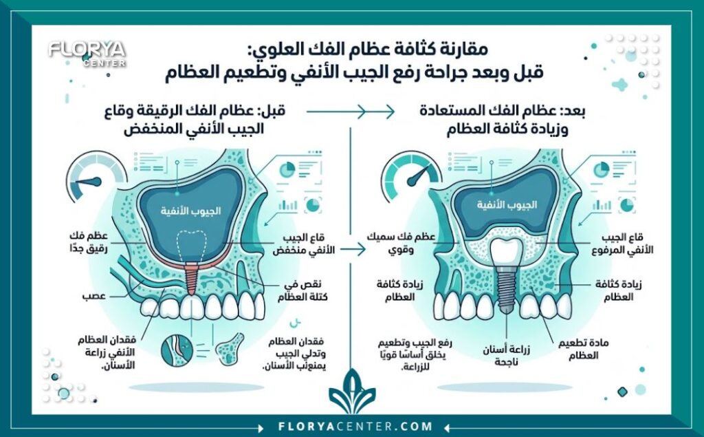 زراعة عظم الفك السفلي في تركيا 3 إنفوجرافيك يقارن بين حالة الفك السفلي المتآكل قبل وبعد زراعة العظم ووضع الغرسات السنية لتعويض الأسنان المفقودة.