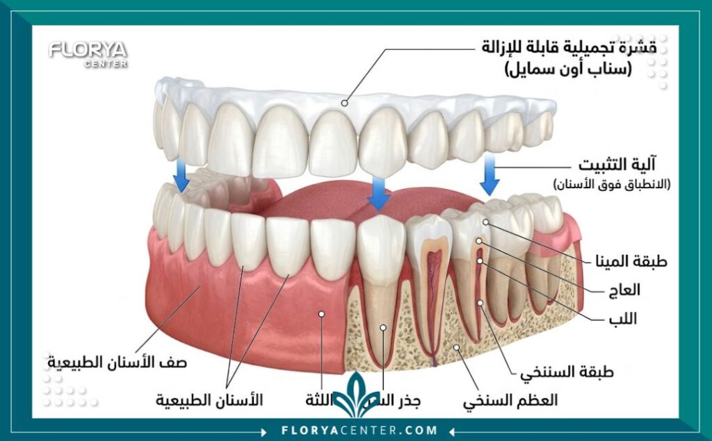 سعر ابتسامة هوليود المتحركة 2 رسم توضيحي طبي يشرح كيفية تثبيت وتركيب ابتسامة هوليود المتحركة فوق الأسنان الطبيعية بدون نحت.