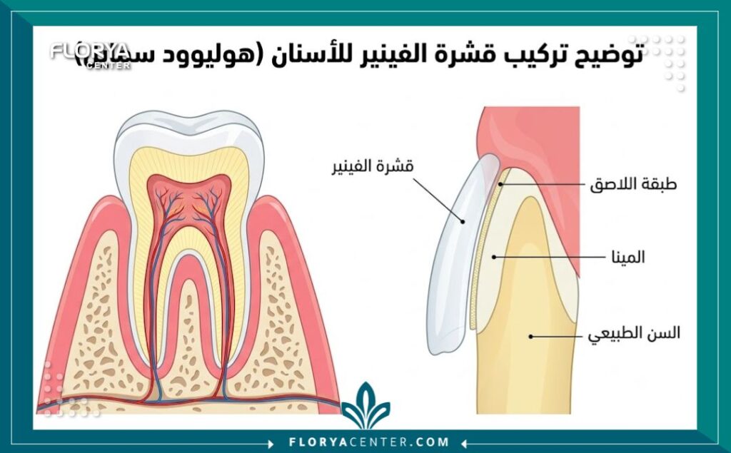 مخطط طبي توضيحي لخطوات وتركيب قشور ابتسامة هوليود الرقمية ثلاثية الأبعاد.