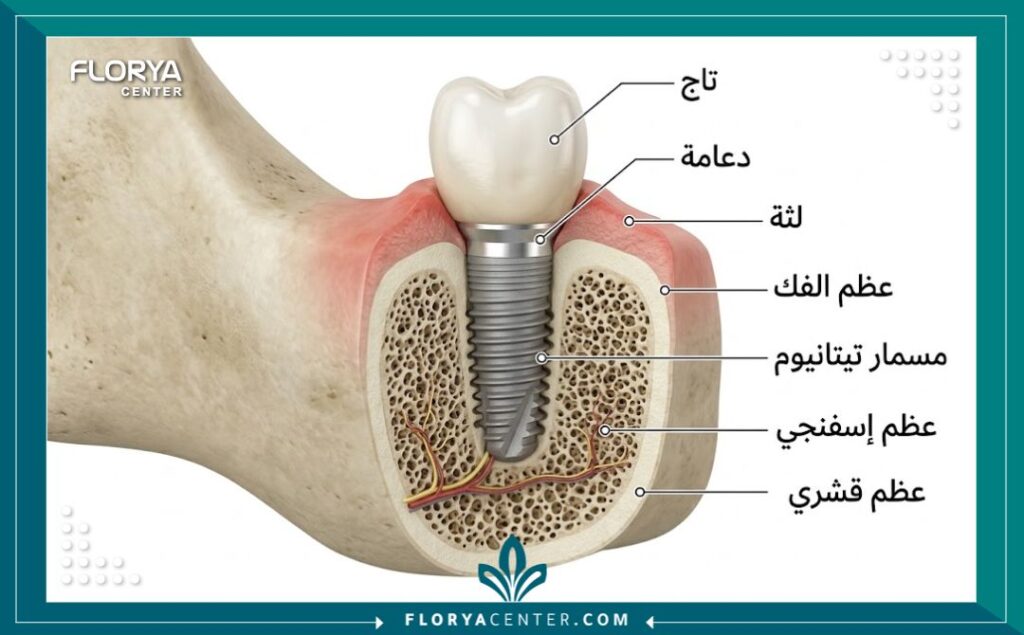 سعر استشارة زراعة الاسنان 2 رسم توضيحي طبي يبين شكل زراعة الأسنان داخل عظم الفك وأهمية الفحص قبل الزراعة.