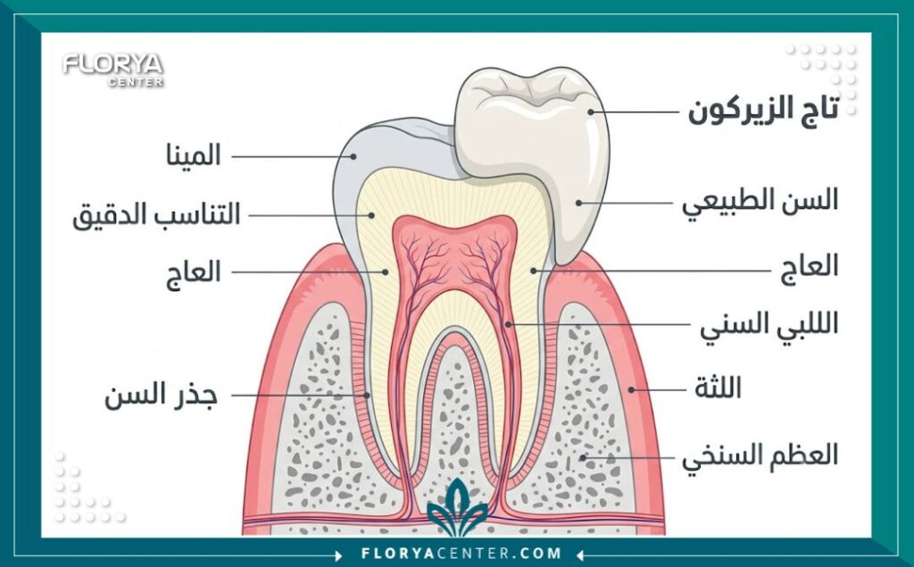 مخطط تشريحي يوضح مكونات تركيبة أسنان الزيركون الخالية من المعدن ومزاياها