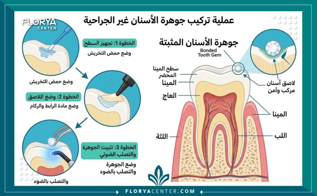 سعر تركيب ماسة السن في تركيا 2 مخطط توضيحي لآلية تركيب ماسة السن بأمان على طبقة المينا دون حفر.