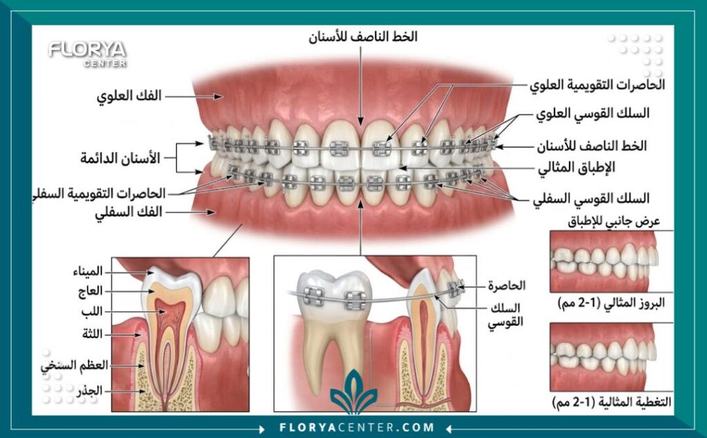 رسم توضيحي طبي دقيق لتركيب تقويم الأسنان على الفكين العلوي والسفلي لتصحيح الإطباق.