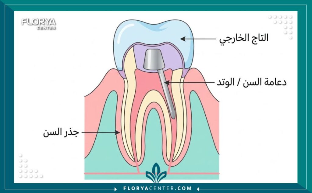 رسم تخطيطي يوضح كيفية تركيب دعامة السن الداخلية أو الوتد داخل الجذر