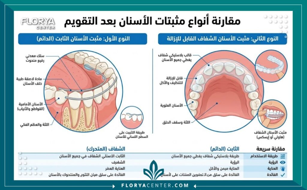 رسم تخطيطي توضيحي لمكونات مثبت الأسنان الشفاف والمعدني الدائم بعد التقويم.