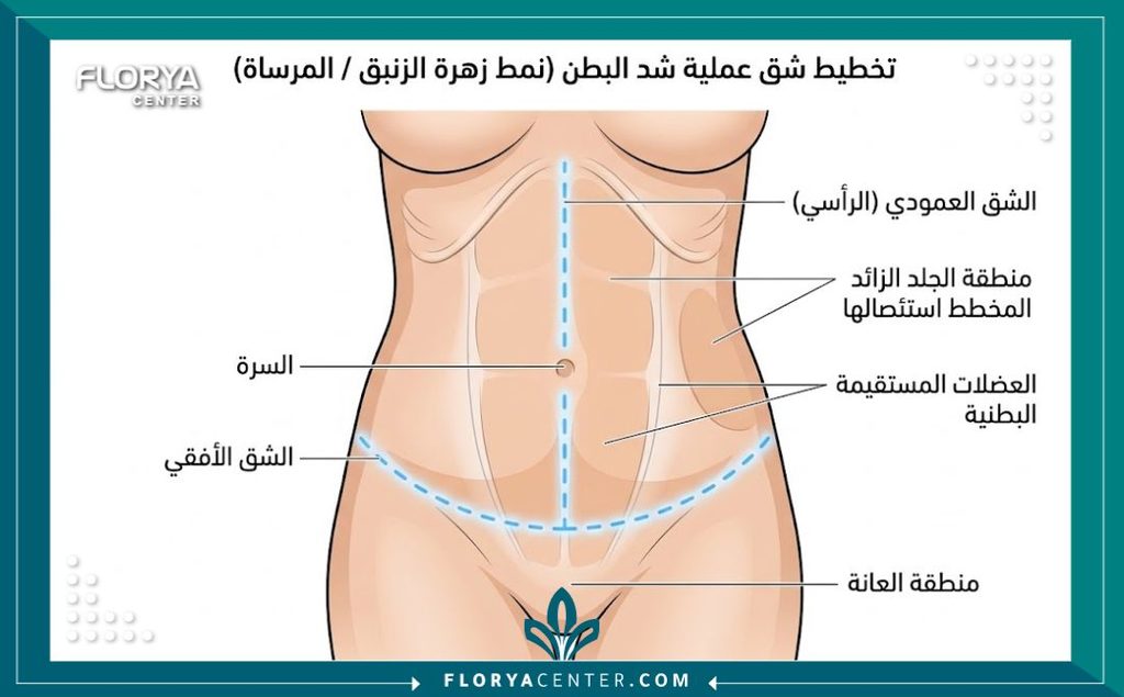 شد البطن المقلوب (Fleur-de-Lis) 2 رسم توضيحي طبي يوضح الشق الطولي والعرضي في جراحة شد البطن المقلوب (Fleur-de-Lis) لإزالة الترهلات الشديدة من كل الاتجاهات.