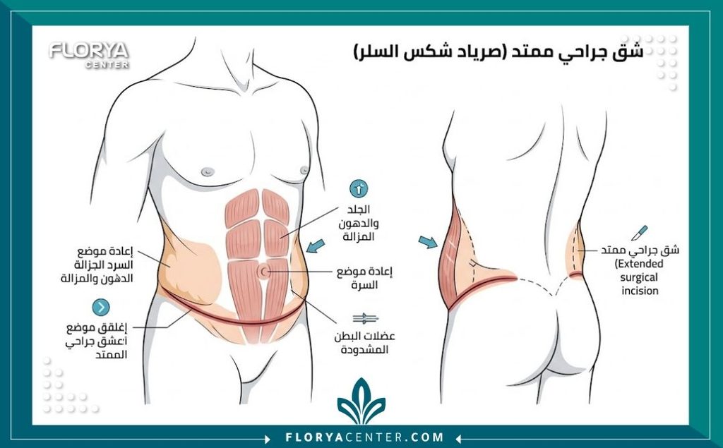 رسم توضيحي طبي يوضح مسار الشق الجراحي في عملية شد البطن الممتد وكيفية استئصال ترهلات الخصر والظهر.