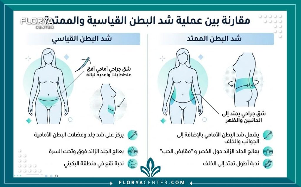 إنفوجرافيك طبي يقارن بين شد البطن التقليدي وشد البطن الممتد لعلاج الترهلات الجانبية.