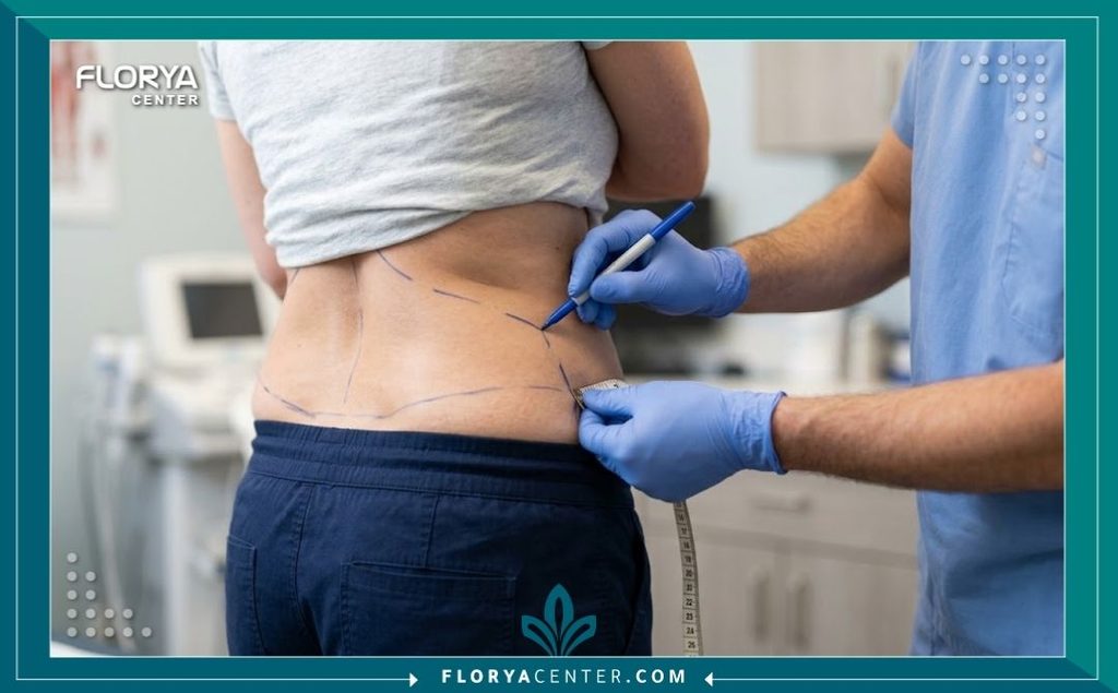طبيب التجميل يقوم بتحديد مناطق الترهل في الخصر والظهر قبل إجراء جراحة شد البطن الممتد.