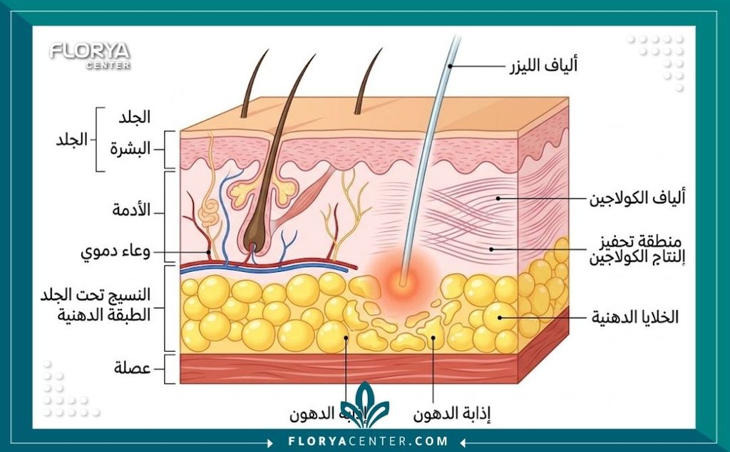 رسم توضيحي طبي لطبقات الجلد يوضح آلية عمل جهاز إندوليفت لشد الترهلات العميقة بالليزر الداخلي وتحفيز الكولاجين.