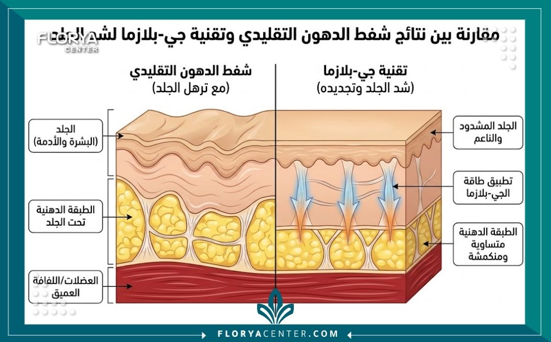 شد الترهلات المتبقية بعد عمليات الشفط السابقة 2 رسم توضيحي طبي يوضح طبقات الجلد المترهل بعد الشفط الخاطئ وكيفية شد الترهلات باستخدام تقنية الجي بلازما.