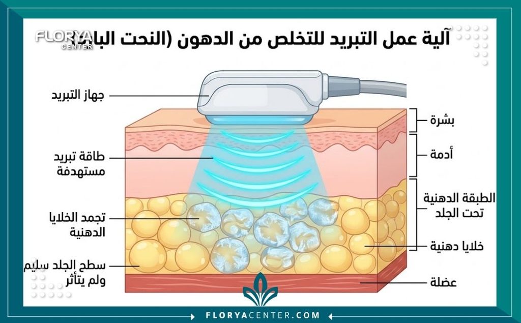 رسم توضيحي طبي لطبقات الجلد يشرح كيفية عمل تقنية تجميد الخلايا الدهنية كحل لا جراحي للتخلص من الدهون دون الإضرار بالجلد.