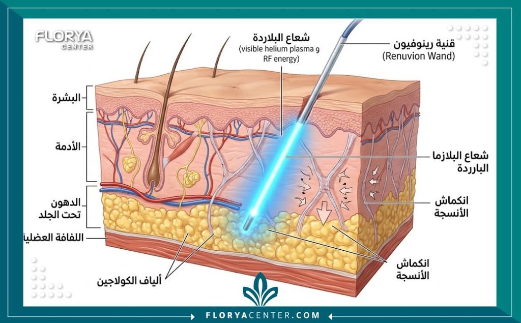 رسم توضيحي طبي لطبقات الجلد يوضح كيف تعمل تقنية رينوفيون للبلازما الباردة على انكماش الكولاجين وشد الجلد من الداخل.