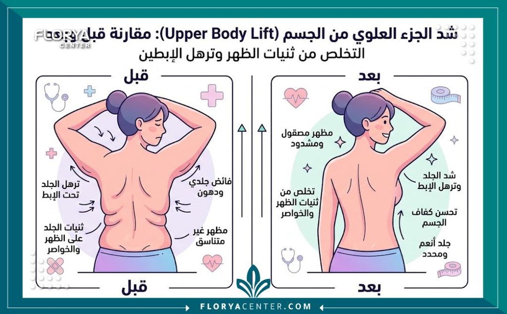 إنفوجرافيك يقارن بين حالة الجسم قبل وبعد عملية شد الجسم العلوي والتخلص من طيات الظهر المزعجة.