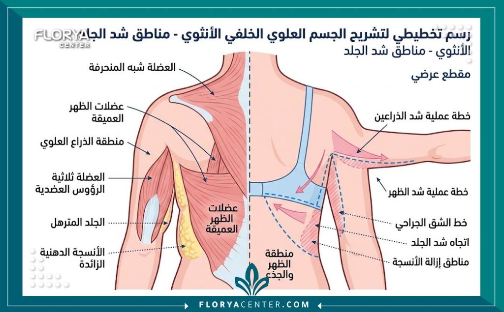 رسم توضيحي طبي يشرح تشريح المناطق المستهدفة في عملية شد الجسم العلوي وعلاج ترهلات الظهر والذراعين.
