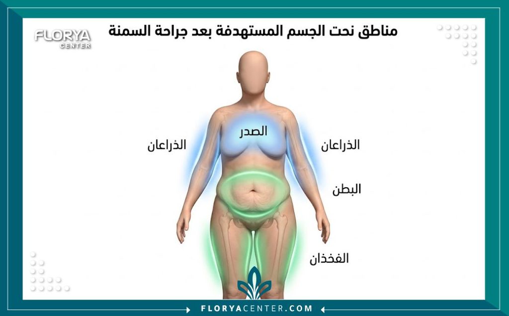 رسم توضيحي طبي للمناطق المستهدفة في جراحات شد الجسم بعد التكميم مثل البطن والذراعين والفخذين.