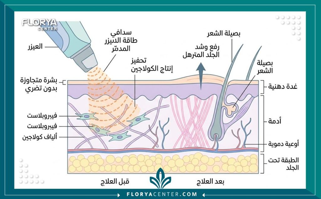 رسم توضيحي طبي يوضح كيف تخترق موجات الليزر طبقات الجلد العميقة لتحفيز الكولاجين وشد الترهلات.