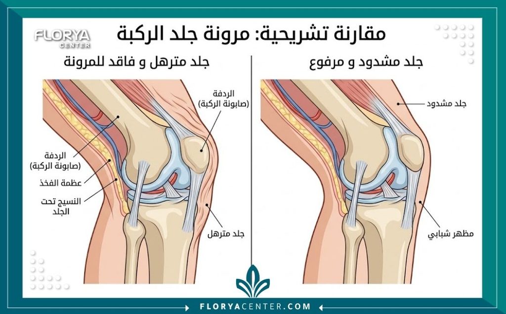رسم توضيحي طبي يشرح تشريح منطقة الركبة والفرق بين الجلد المترهل والجلد المشدود بعد عملية تجميل الركبتين.