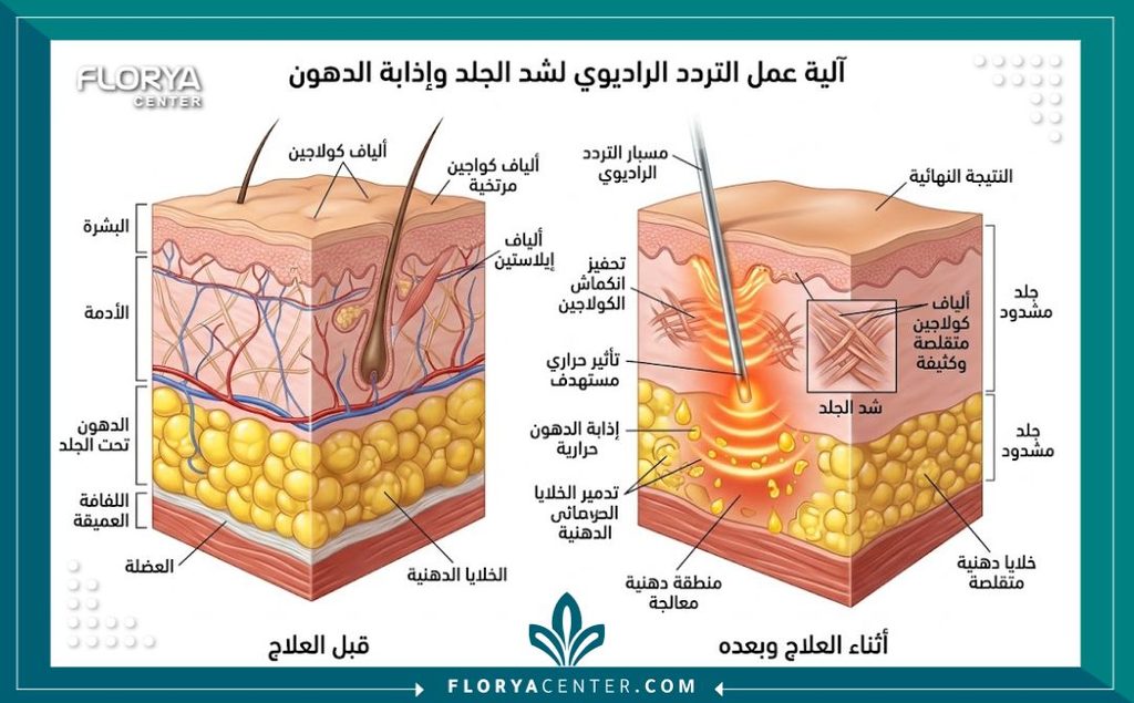 رسم توضيحي طبي يوضح آلية عمل جهاز البودي تايت في إذابة الدهون وشد الجلد بالترددات الراديوية الداخلية.